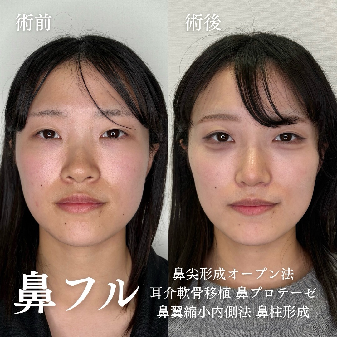 鼻尖形成(オープン法)+耳介軟骨移植+鼻プロテーゼ+小鼻縮小(内側法)の症例