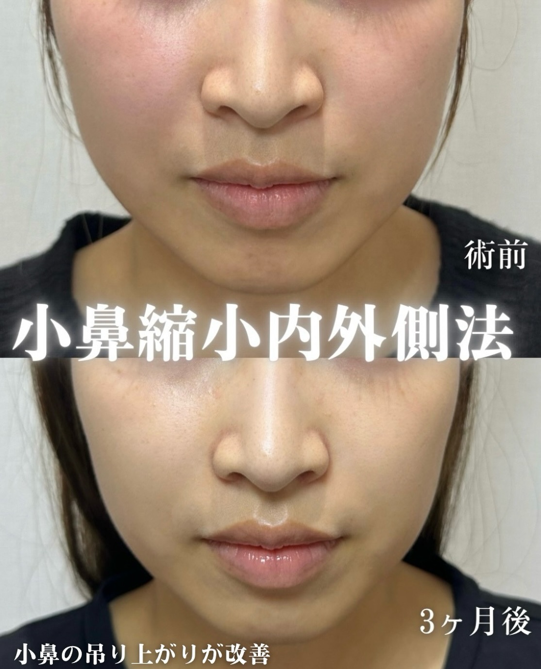 小鼻縮小(内外側法)の症例