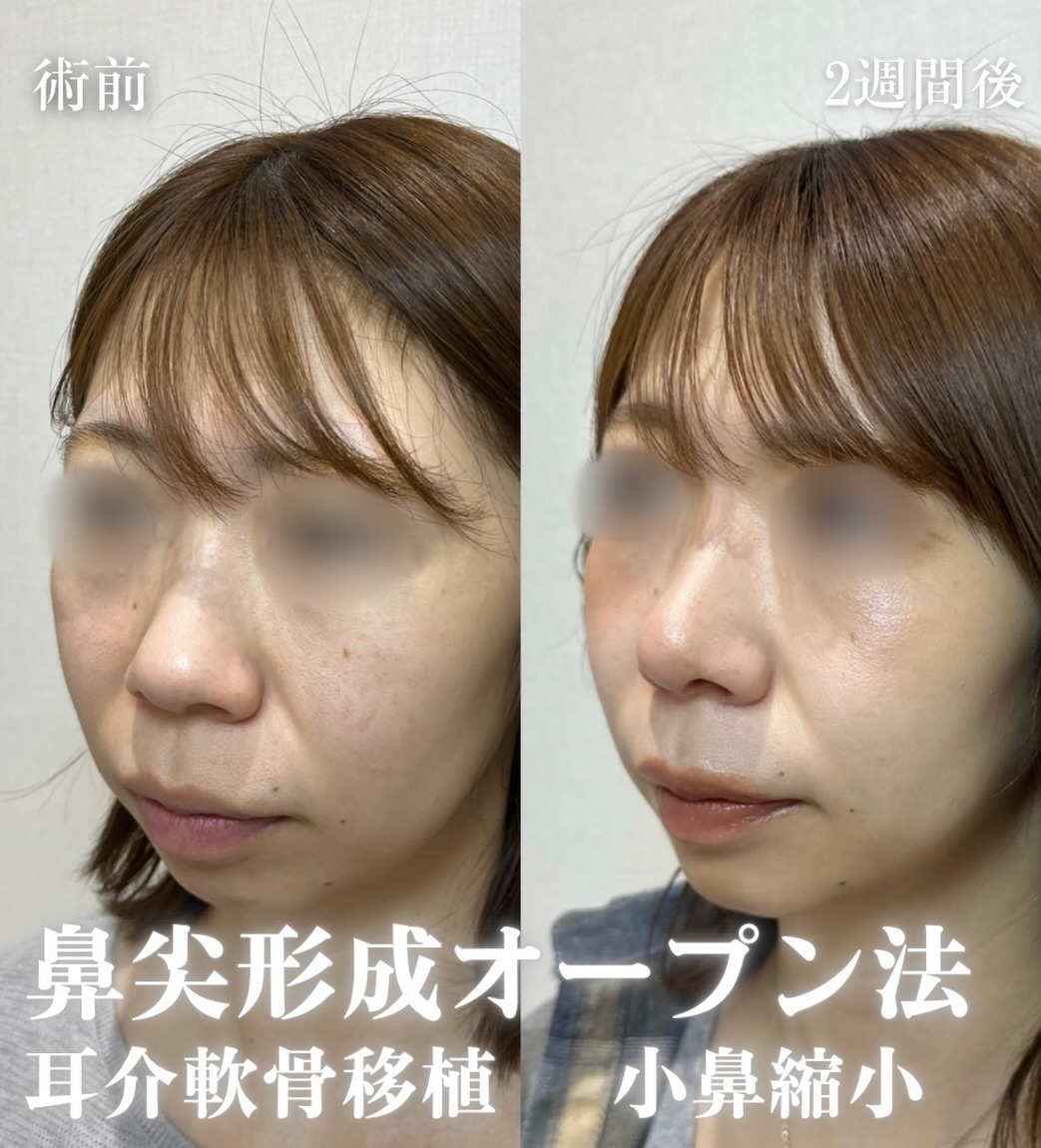 鼻尖形成(オープン法)+耳介軟骨移植+小鼻縮小の症例