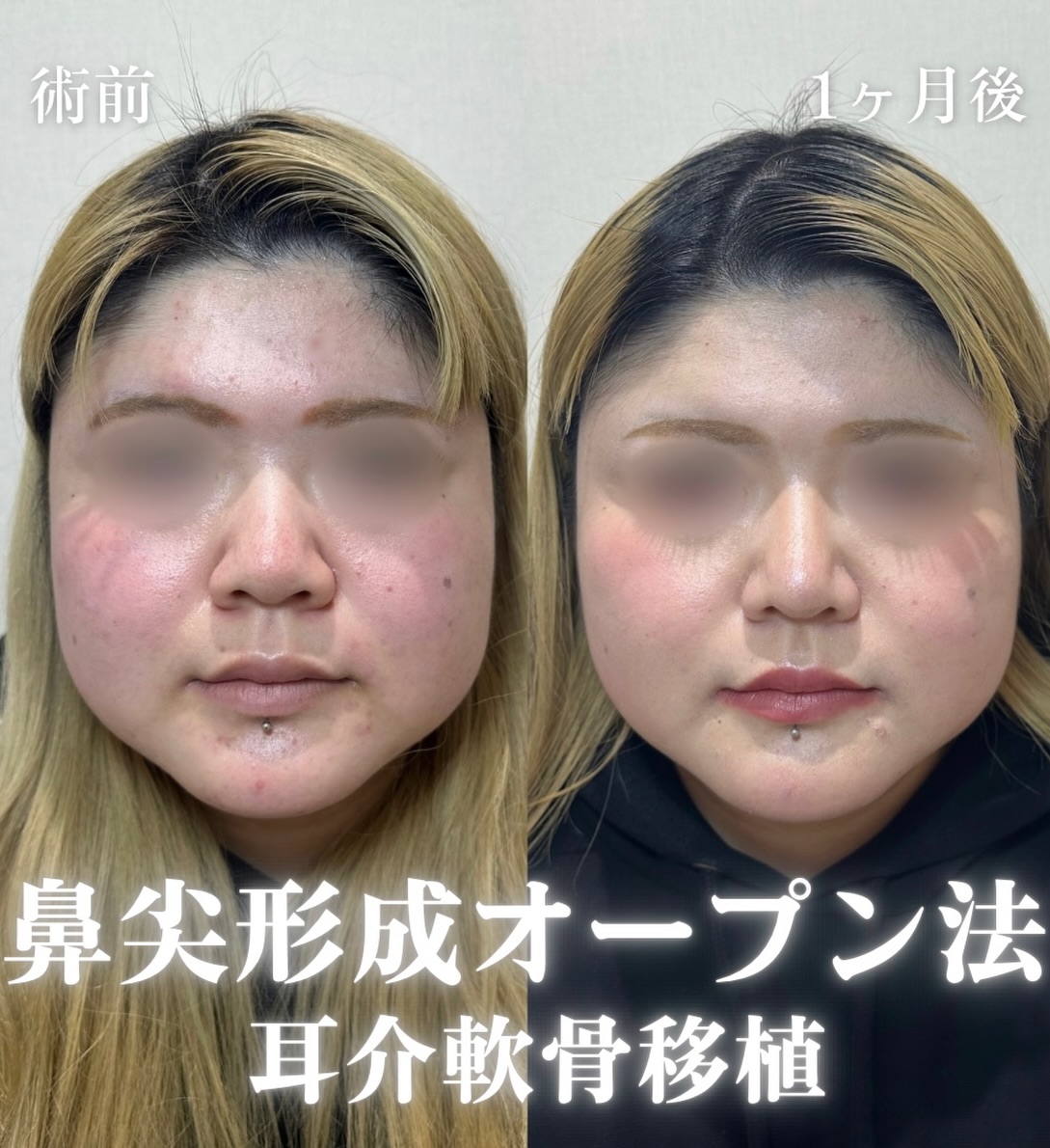 鼻尖形成(オープン法)+耳介軟骨移植の症例