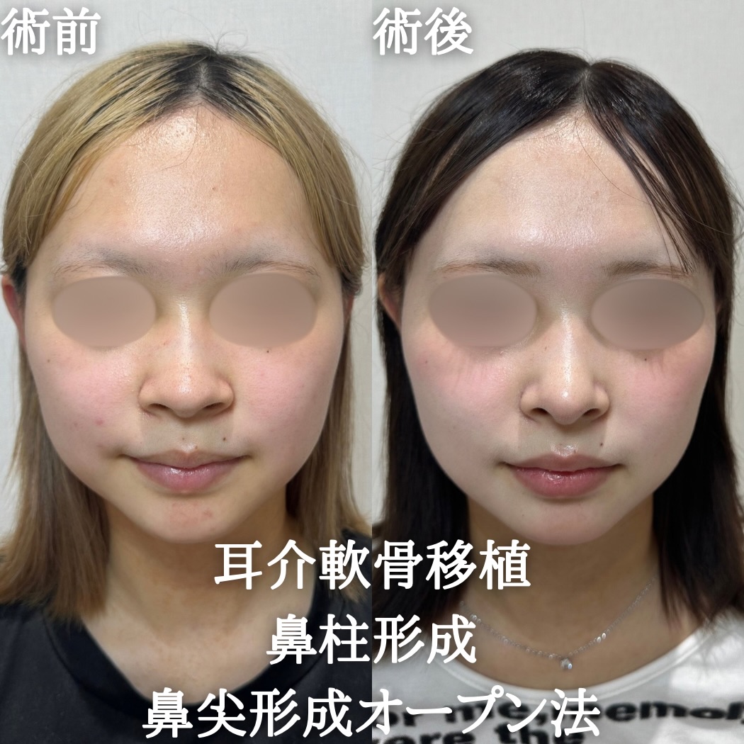 耳介軟骨移植+鼻尖形成(オープン法)+鼻柱形成+小鼻縮小(外側法)の症例