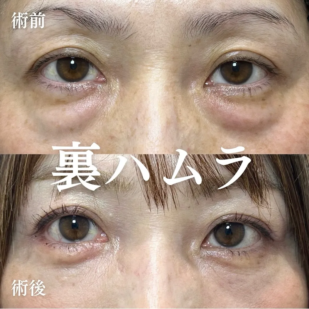 裏ハムラ法の症例