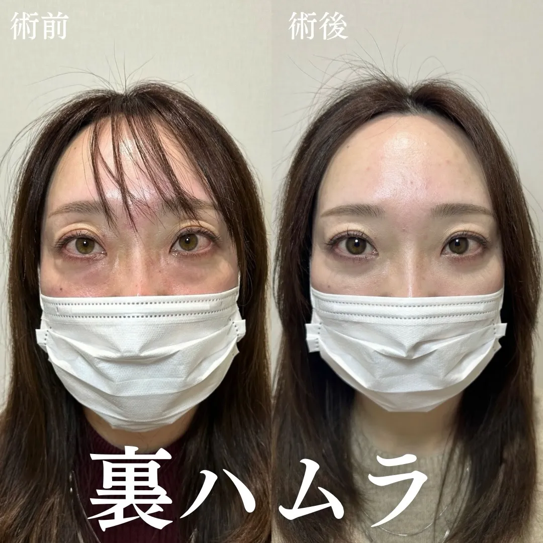 裏ハムラ法の症例
