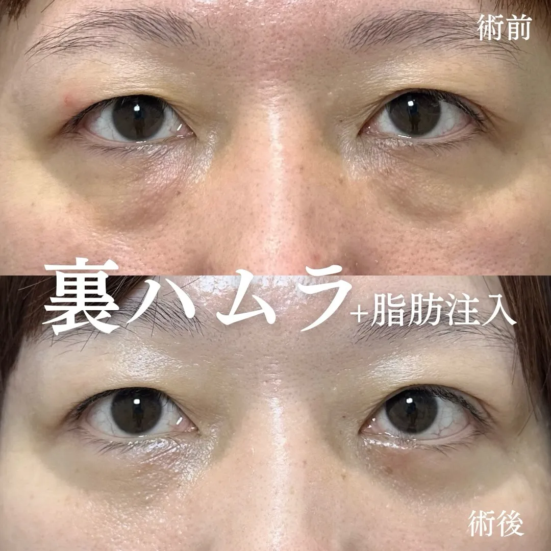 裏ハムラ法+脂肪注入の症例