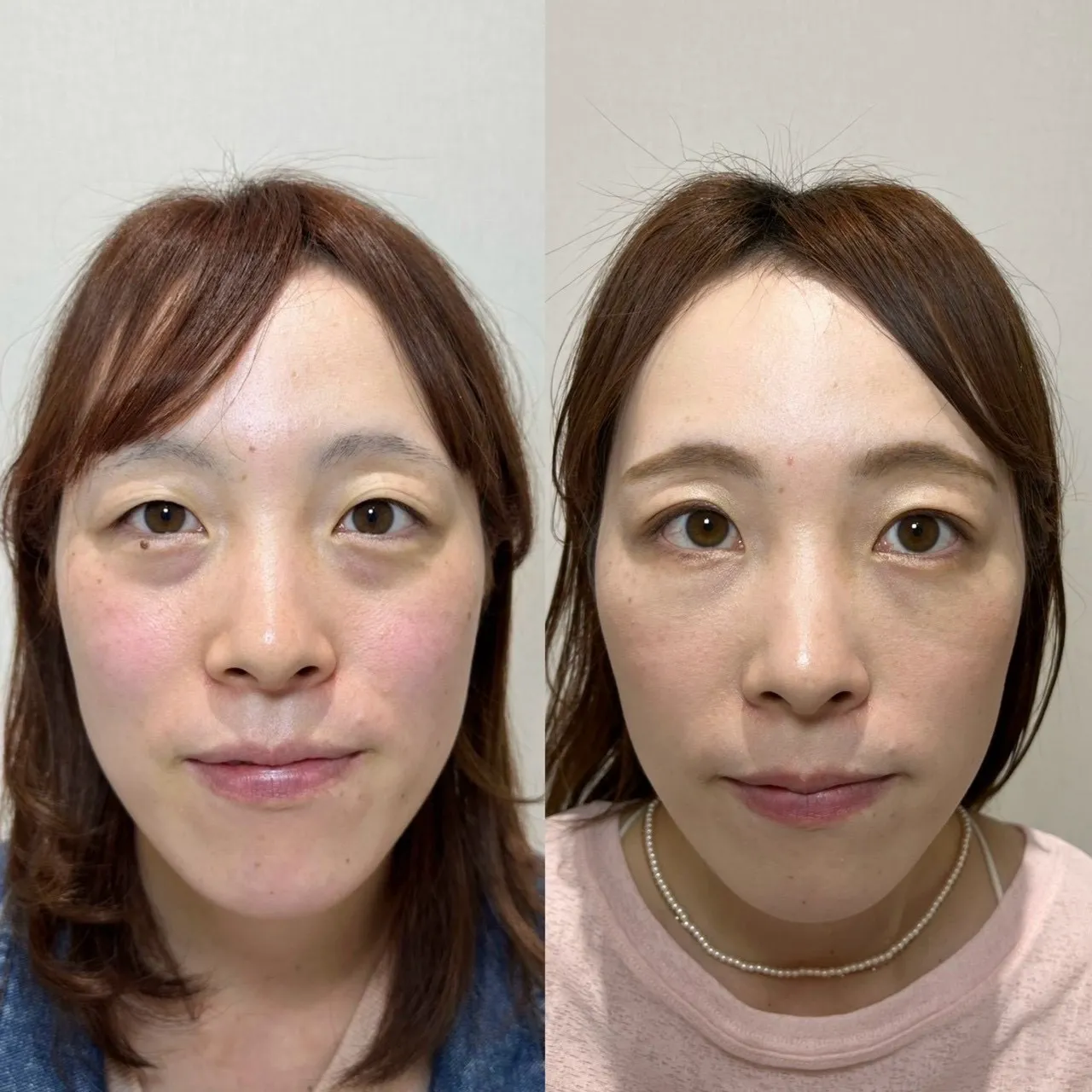 裏ハムラ法の症例