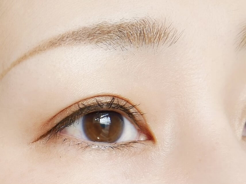 二重整形の施術方法の種類