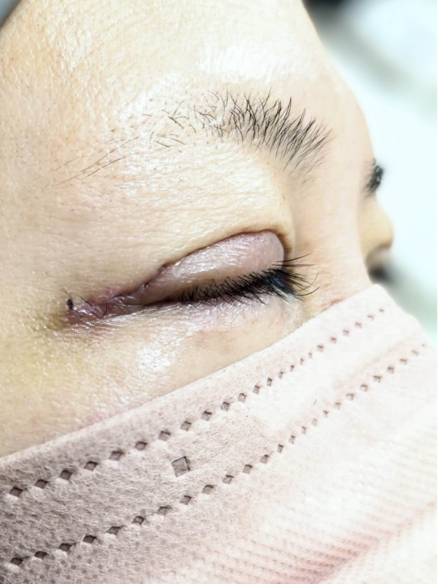 埋没法の術後経過：腫れ・内出血の目安