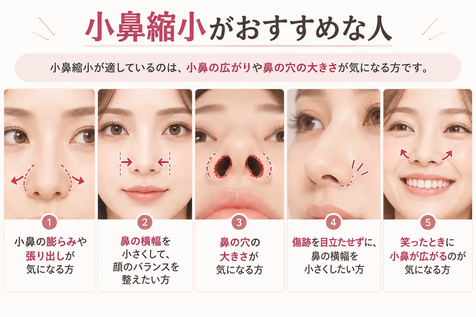 小鼻縮小がおすすめな人:小鼻の膨らみや張り出し、鼻の横幅、鼻の穴の大きさ、笑ったときの小鼻の広がりが気になる方