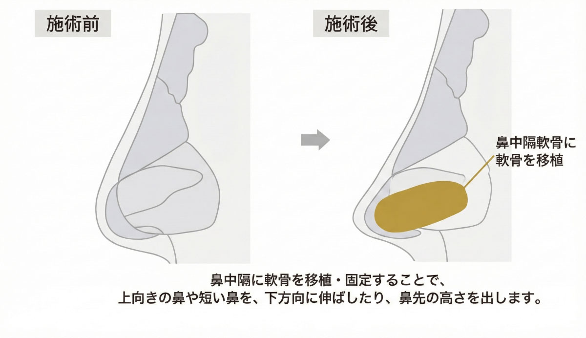 鼻中隔延長施術イメージ