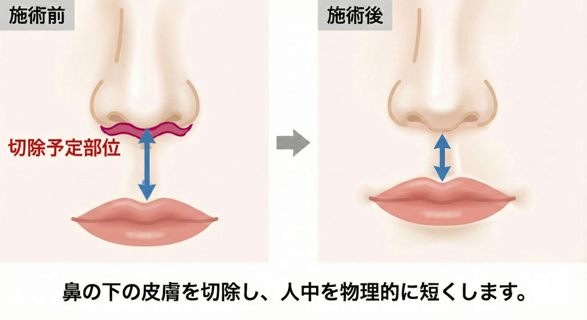 人中短縮施術イメージ